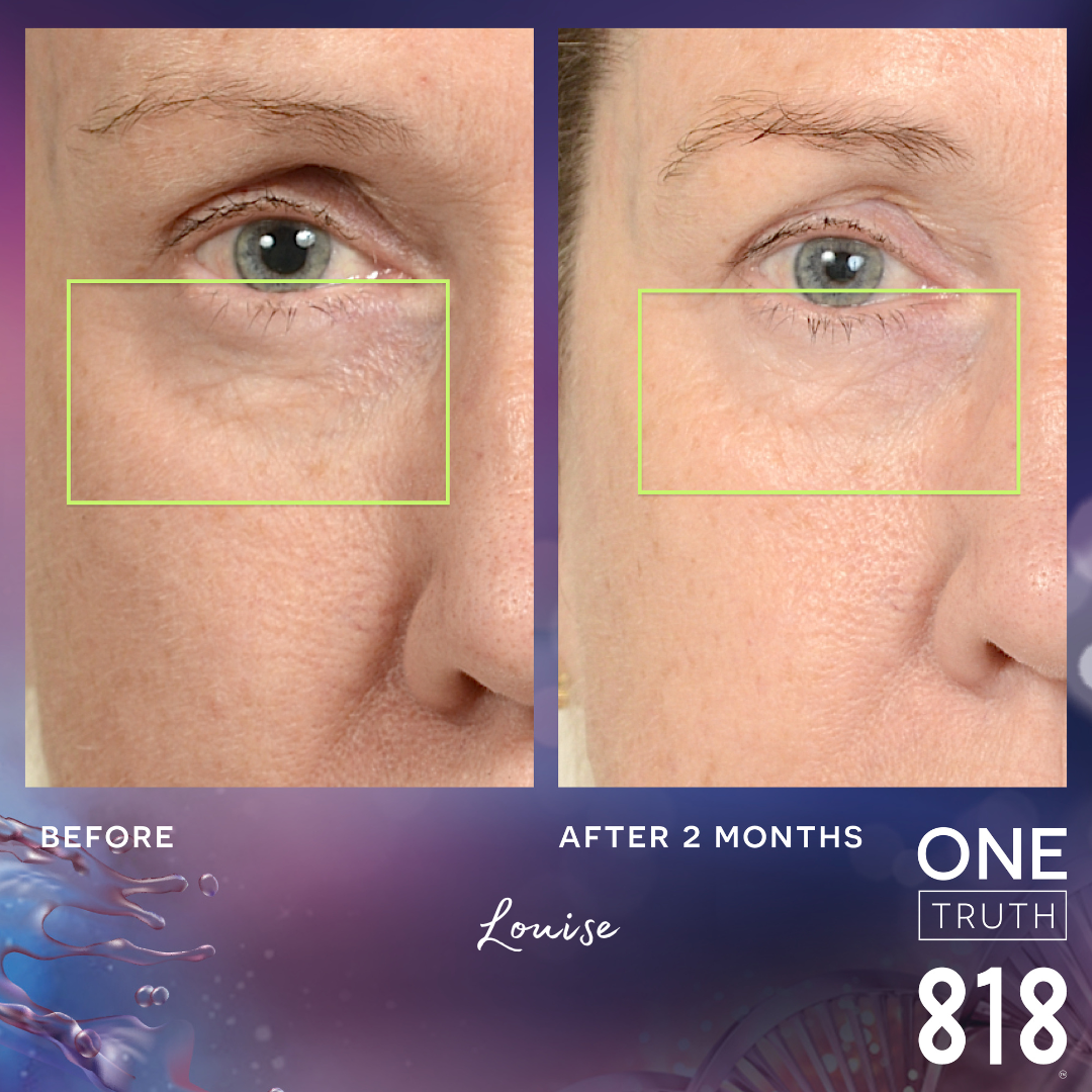 Before and Afters – One Truth 818 Australia